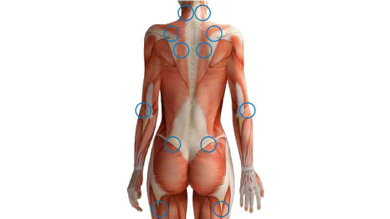 Fibromyalgia Potential Causes and Treatments