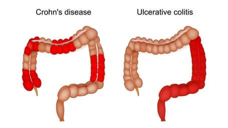 Causes of Crohn's Disease and Ulcerative Colitis