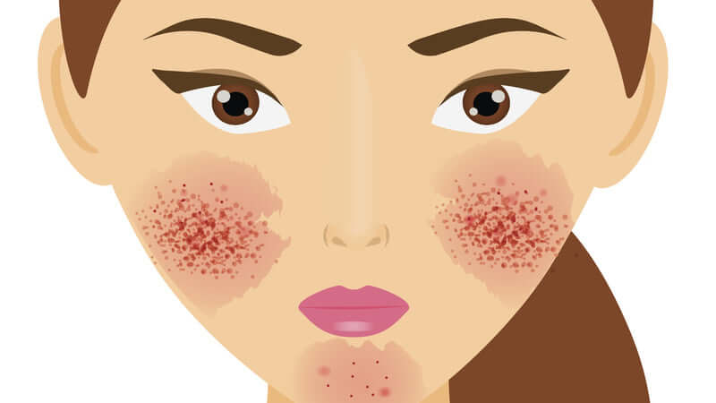 Rosacea