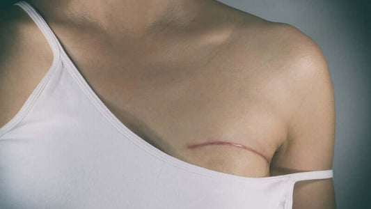 Close-up of a person's chest showing a healing scar after surgery, highlighting the effects of medical procedures.