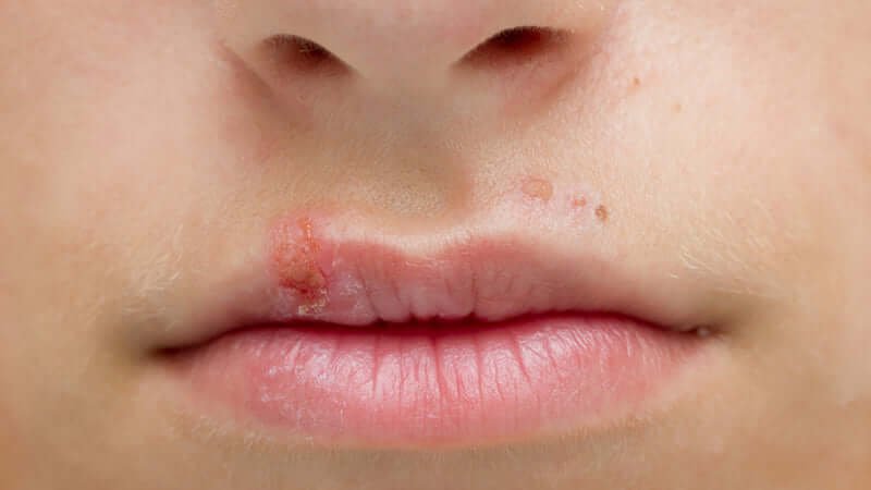 Herpes Virus Diseases
