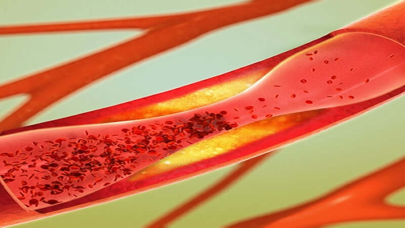 Arterial Plaque Defined
