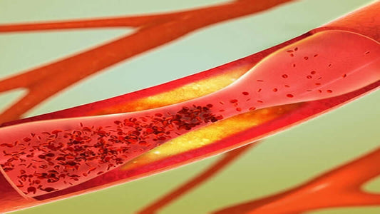 Arterial Plaque Defined