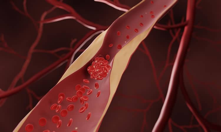 Atherosclerosis