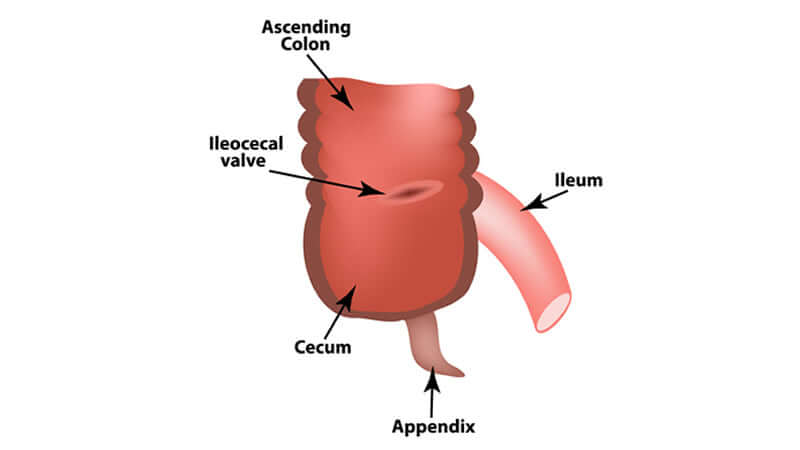 Ileocecal Valve Syndrome