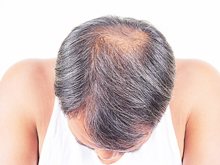 Image depicting hair loss, highlighting the importance of Support for Hair Health.