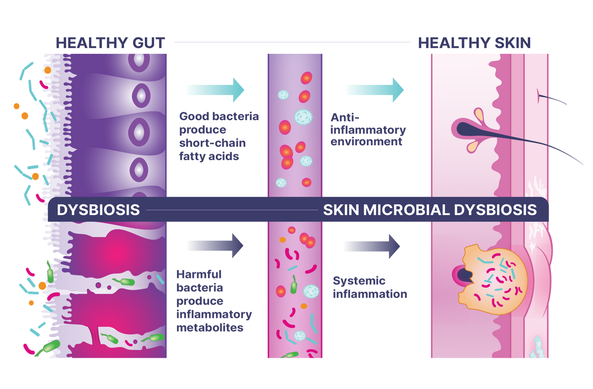 Illustration showing the relationship between healthy gut, healthy skin, dysbiosis, and skin microbial dysbiosis Digestive Enzyme and Probiotic