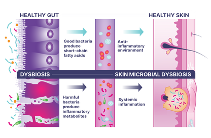 Illustration showing the relationship between healthy gut, healthy skin, dysbiosis, and skin microbial dysbiosis Digestive Enzyme and Probiotic